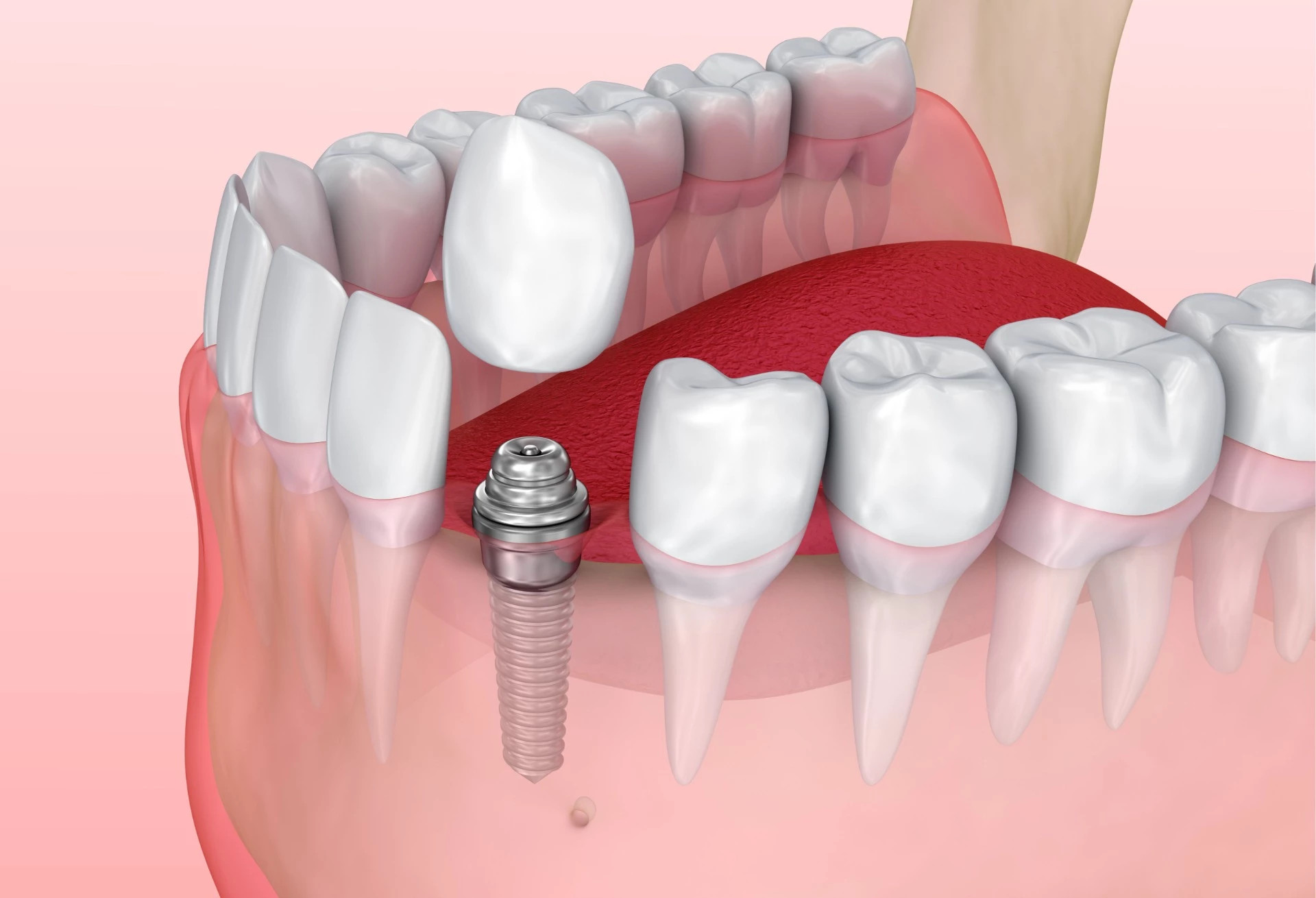 Porselenskrone på implantat